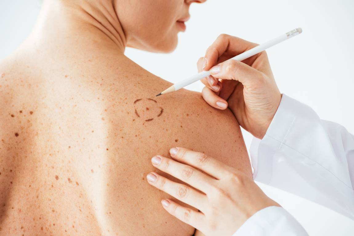 The 5 Best Mole Removal Clinics in Calgary